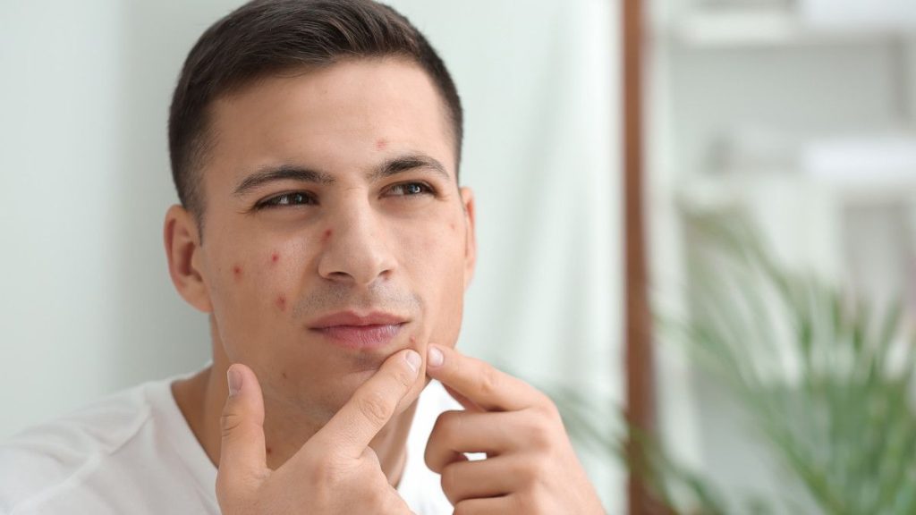 tips merawat wajah pria yang berminyak dan berjerawat